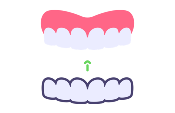 Clear Aligners